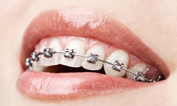 Types of Braces, Statler Orthodontics